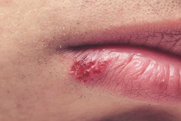 mụn rộp sinh dục ở miệng là gì điều trị thế nào