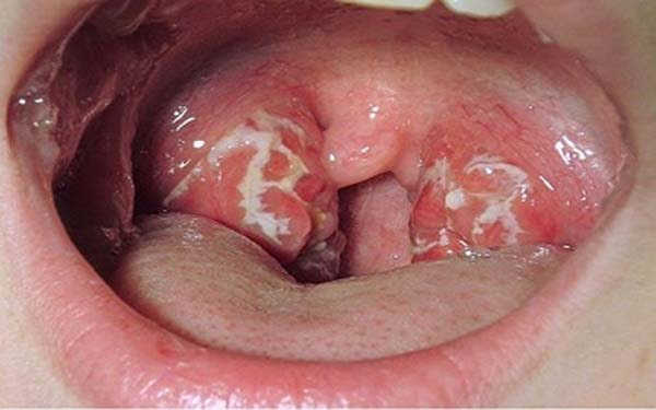 dấu hiệu bệnh lậu ở miệng