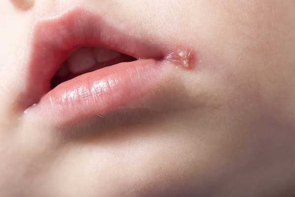 herpes sinh dục ở miệng