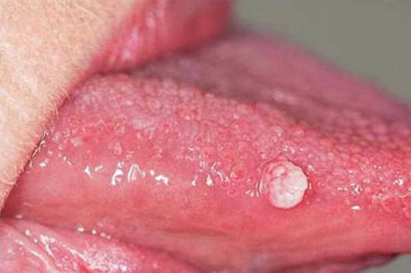 lưỡi bị nổi mụn đỏ do mụn rộp sinh dục