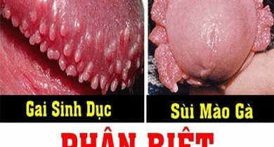 gai sinh dục khác sùi mào gà như thế nào