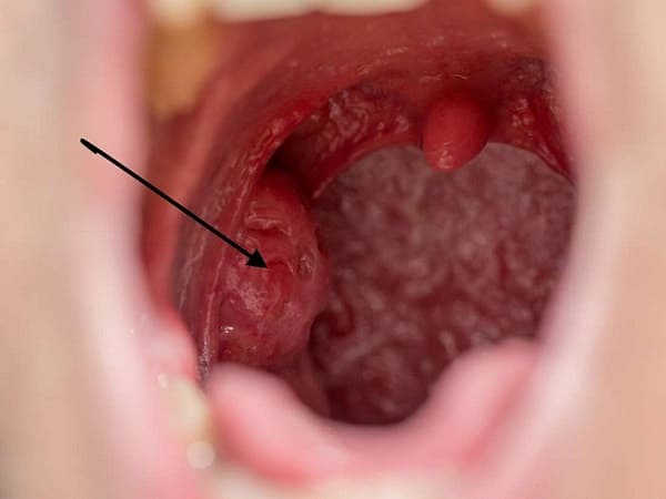 ung thư vòm họng giai đoạn 1