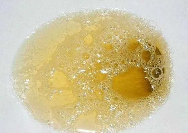nước tiểu màu vàng đục 2